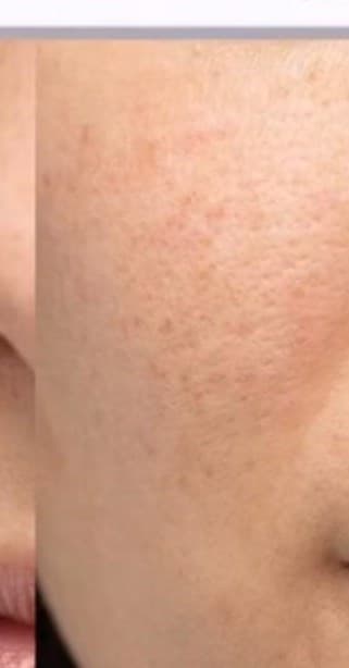 Après — Laser vasculaire